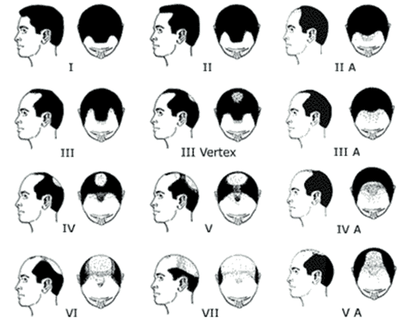 classificazione_alopecia